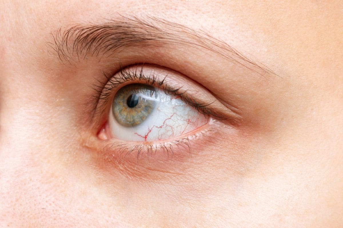 Dry Eyes Vs. Eye Allergies: Know The Difference